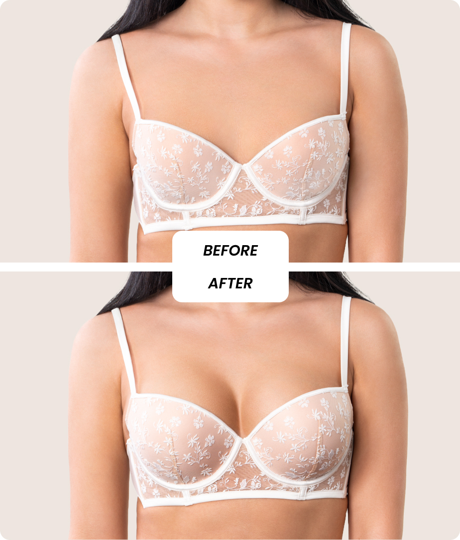 Breast Reshaping  Beauté Concept Clinic Dubai