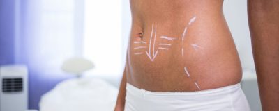 5 Things No One Tells You About Liposuction