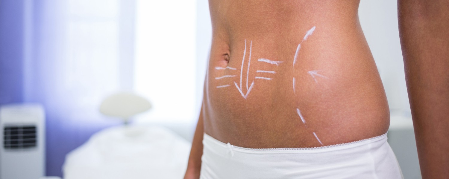 5 Things No One Tells You About Liposuction